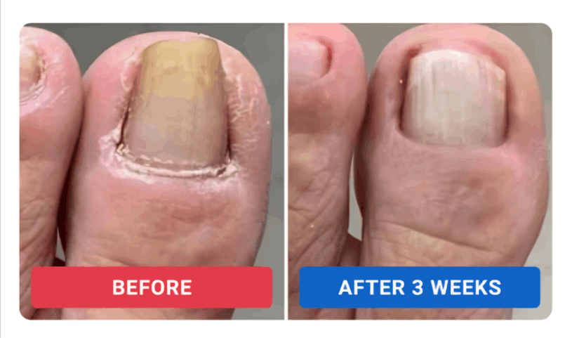 Orivelle Nail Fungus Pen review by Dan R.