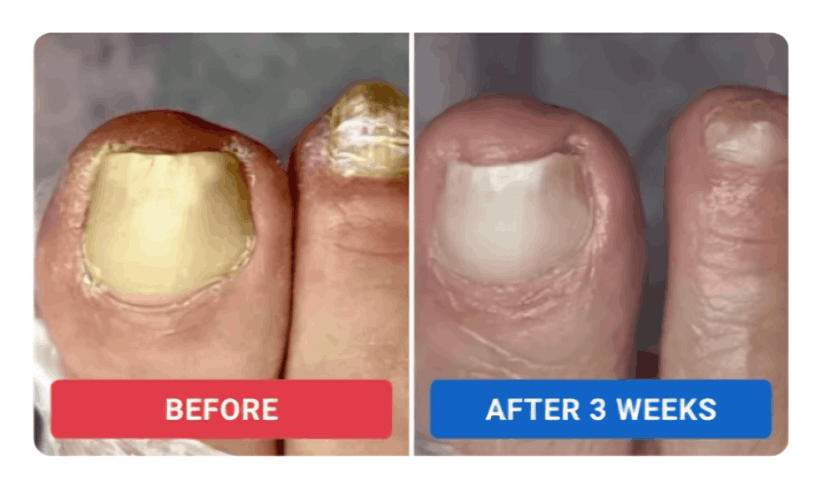 Orivelle Nail Fungus Pen review by Elena S.