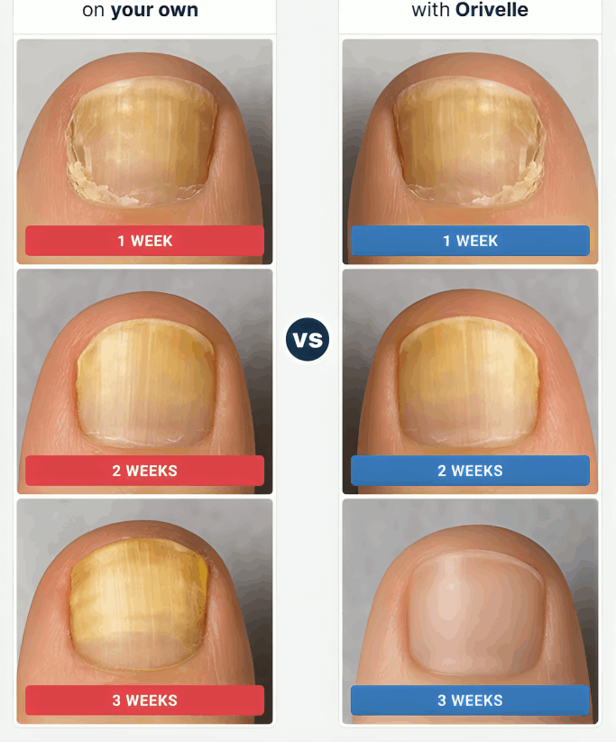 Orivelle Nail Fungus Pen before and after